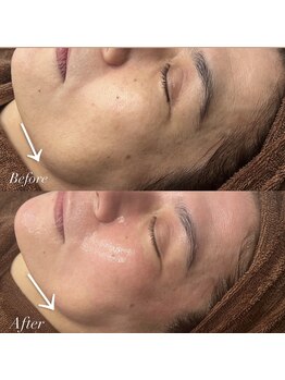 アトリエ エテ バイ ニココ(atelier ete by nicoco)/陶肌トリートメント