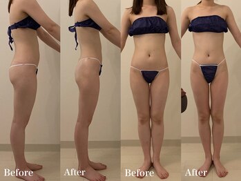 ラヴィエ ベル(La vie est belle)/セルライトゼロ2 全身