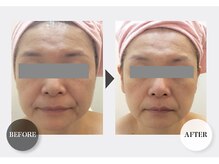 ワンバイゼロ(One by zero)/ハーブピーリング