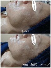 ベルクラージュ(Belle Courage)/50代　小顔・リフトアップ