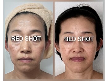 シャルマーミ/目の下脂肪撃退　RED　SHOT