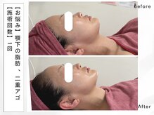 レッド(RED)/顎下削りで綺麗なEラインを☆