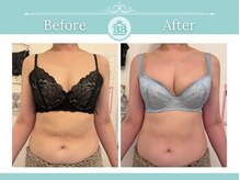 美人バスト 新潟店/ 【バストアップ★育乳】症例