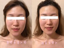 ホワイトサロンファミリア(whitesalon familia)/小顔コルギ＋毛穴洗浄＋美容液