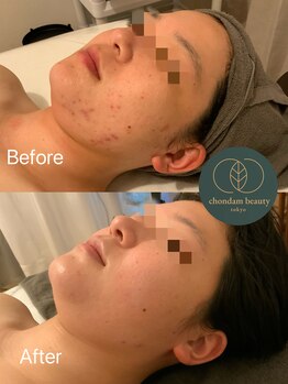 チョンダムビューティー(chondam beauty)/ニキビケアはお任せください♪