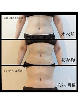 アリビオ(ALIVIO)/美容施術前インディバモニター