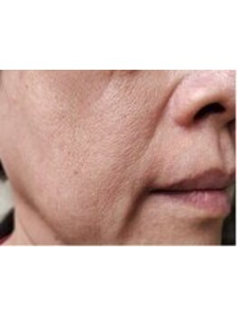 ホウレイ線・たるみ改善！予防ケア