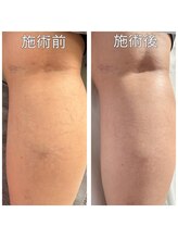 フェルナ(FERNA)/スパイダースキン