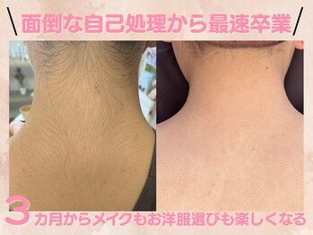 ルミエールブランシュ(Lumiere blanche)/全身脱毛