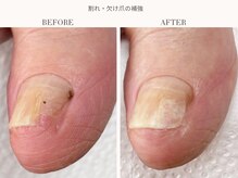 ディグニティ(Dignity)/割れ・欠け爪の補強ケア