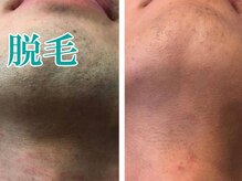 美宝 元町/ヒゲ脱毛で美肌男子へ。