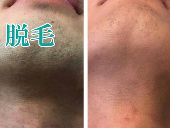 美宝 元町/ヒゲ脱毛で美肌男子へ。