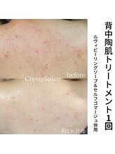 クレヴィー(Creviy)/背中陶肌トリートメント