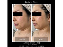 イデアール(ideal)/サーマルフラクション★