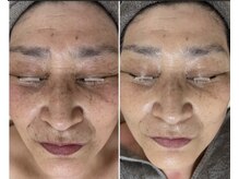 リュミエール(umiere)/たるみケア・シミ改善に◎