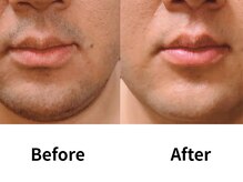 モンロー(MonroE+)/脱毛