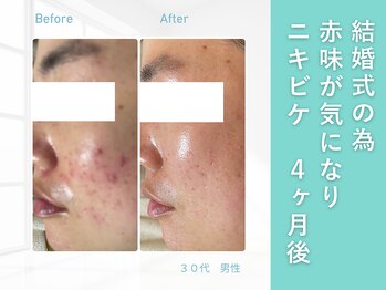 ルナティアラ(LUNAティアラ)/男性ニキビ・毛穴