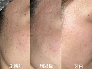 ナーズ(NAZ)/ハイブリット　光フェイシャル