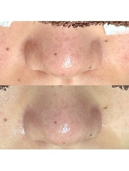 エクラ バイ シャンリィ(eclat by shanLy)/綺麗なお肌ゲット