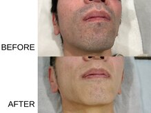 アニュ(a nu)/1か所・都度でも通えるヒゲ脱毛