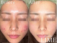 ベル 赤羽(Belle)/ハーブピーリング｜ニキビケア