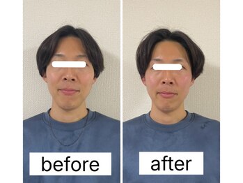 LCFユキ(LCF YUKI)/1回の施術効果 小顔/美容鍼/整体