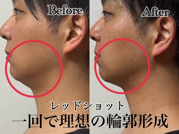 アンドエス 六本木(and S.)/脂肪分解でフェイスライン復活!