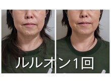 ヨサパーク モックス 堺東(YOSA PARK MOX)/50代前半　ルルオン1回