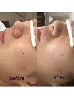 ユルリ(YURURI)/ビフォーアフター(シミケア)