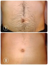 サロンエヌ 久留米店(Salon N)/お腹脱毛before/after