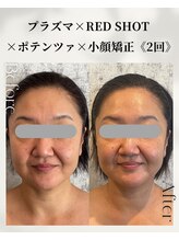 ネイルアンドアンチエイジングドゥシール(Docile)/50代女性｜小顔矯正・たるみ改善