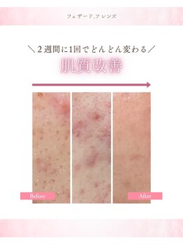 フェザード フレンズ 松山店の写真/    ララピールの次はコレ！進化系パンプキンピールで本気の肌質改善・毛穴レス美肌へ