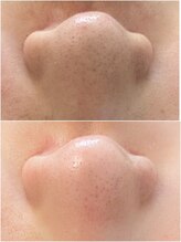 マヴィ 香里園店(MavY.)/毛穴の汚れにみえるのは3種類