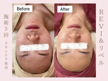 ルア(LuA.)/剥離ありリベルハーブピーリング