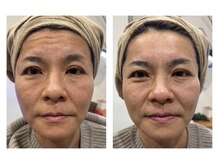 リモレア(RemoLe'a)/美顔筋テラボーラー