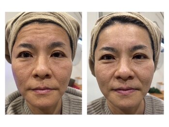 リモレア(RemoLe'a)/美顔筋テラボーラー