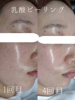 ビー ピボット店(Bee)/乳酸ピーリング