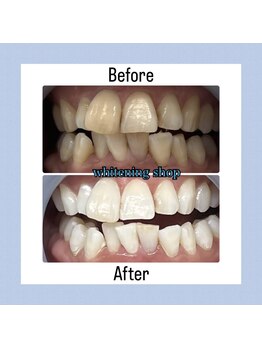 ホワイトニングショップ 今治店/40分×10回Before/After