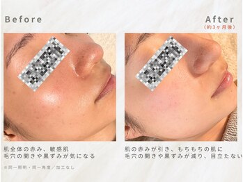 メレ(mele)/20代毛穴／ニキビケア・赤み