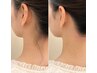 [首長効果]うなじ美人に♪うなじ映え☆うなじワックス脱毛￥7500→￥6500