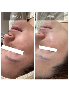 ダリア(Dahlia)/赤ら顔でお悩みの方