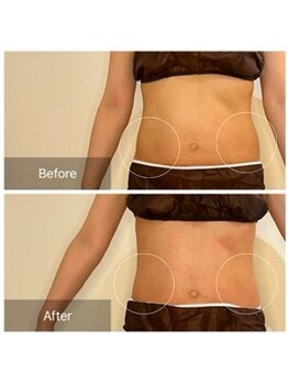 ウィズ ユー ビューティ(with U beauty)/気になる腰肉スッキリ