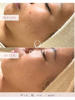 アカリ(acari)/ニキビはもちろん肌自体が綺麗に