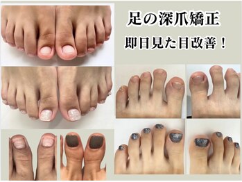 フット深爪即日見た目改善