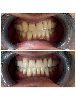 グリッター ショウナン(glitter. SHONAN)/藤沢ホワイトニングbefore/after