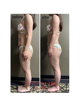 チュラ/ハイパーナイフ/所沢/痩身エステ