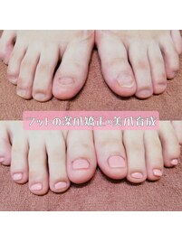 フットの深爪矯正×美爪育成