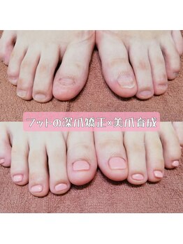 フットの深爪矯正×美爪育成