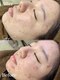 スナイ(SNAY)の写真/ニキビ・毛穴・赤みのお悩みに。専門知識を持つスタッフが徹底サポート!本気で向き合う肌改善サロン