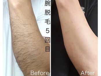 CDF 赤坂/上半身脱毛5回目初回5500